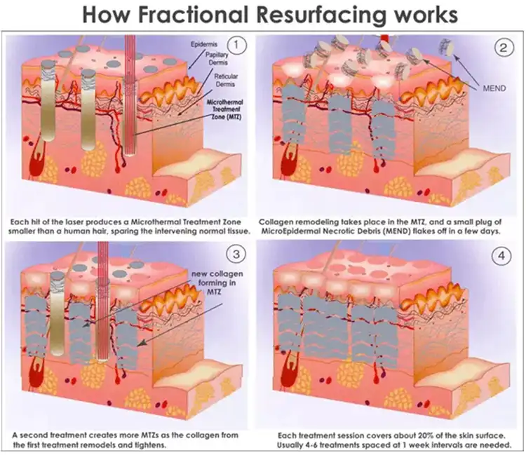 fractional co2 laser detail 2.webp