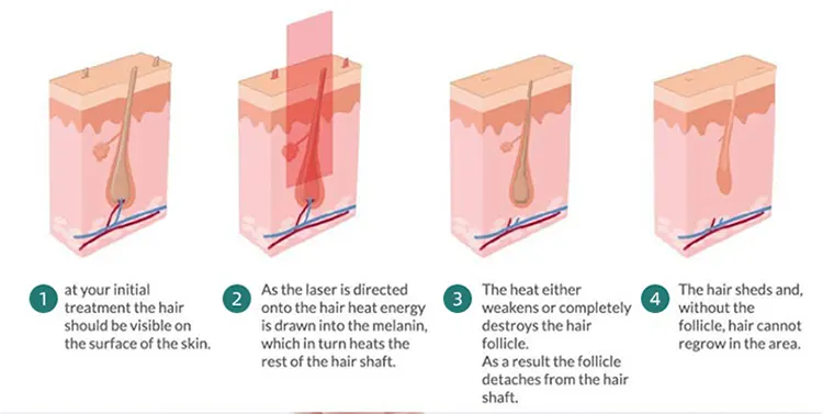 808nm diode laser hair removal principle .webp